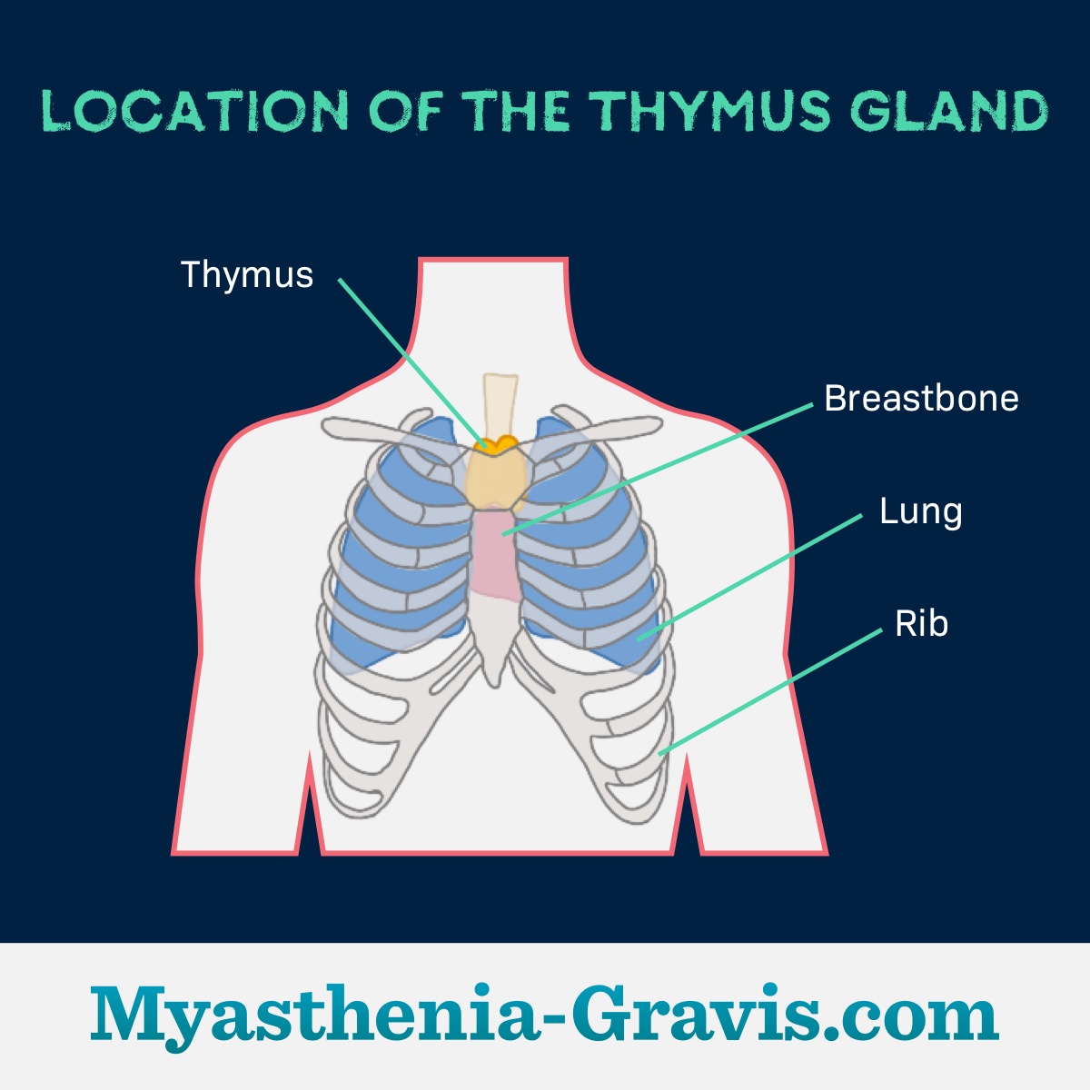 The Impact of Thymomas in Myasthenia Gravis