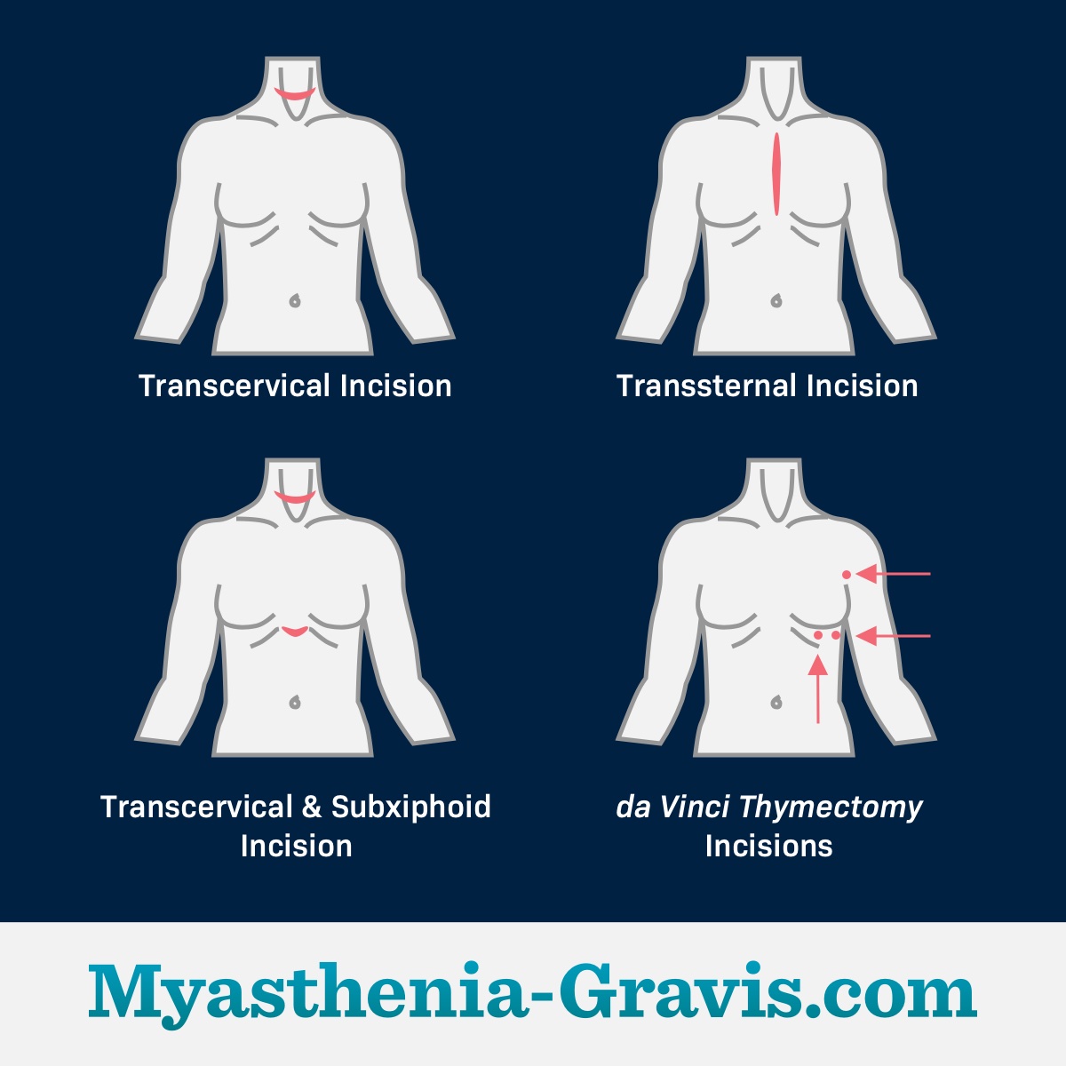 Different types of surgical incisions used in thymectomy for treating myasthenia gravis.