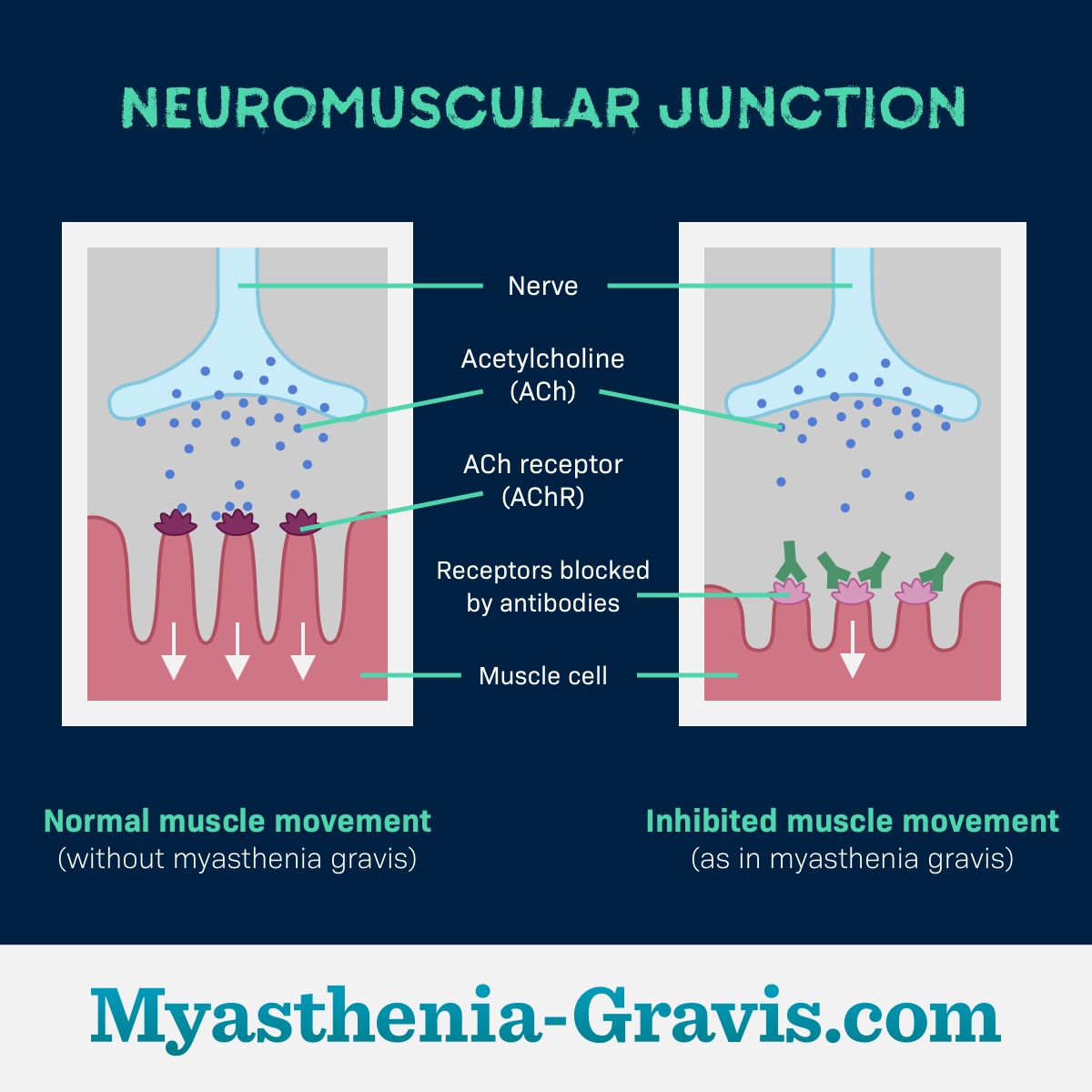 Diagram of a neuromuscular junction with and without myasthenia gravis.