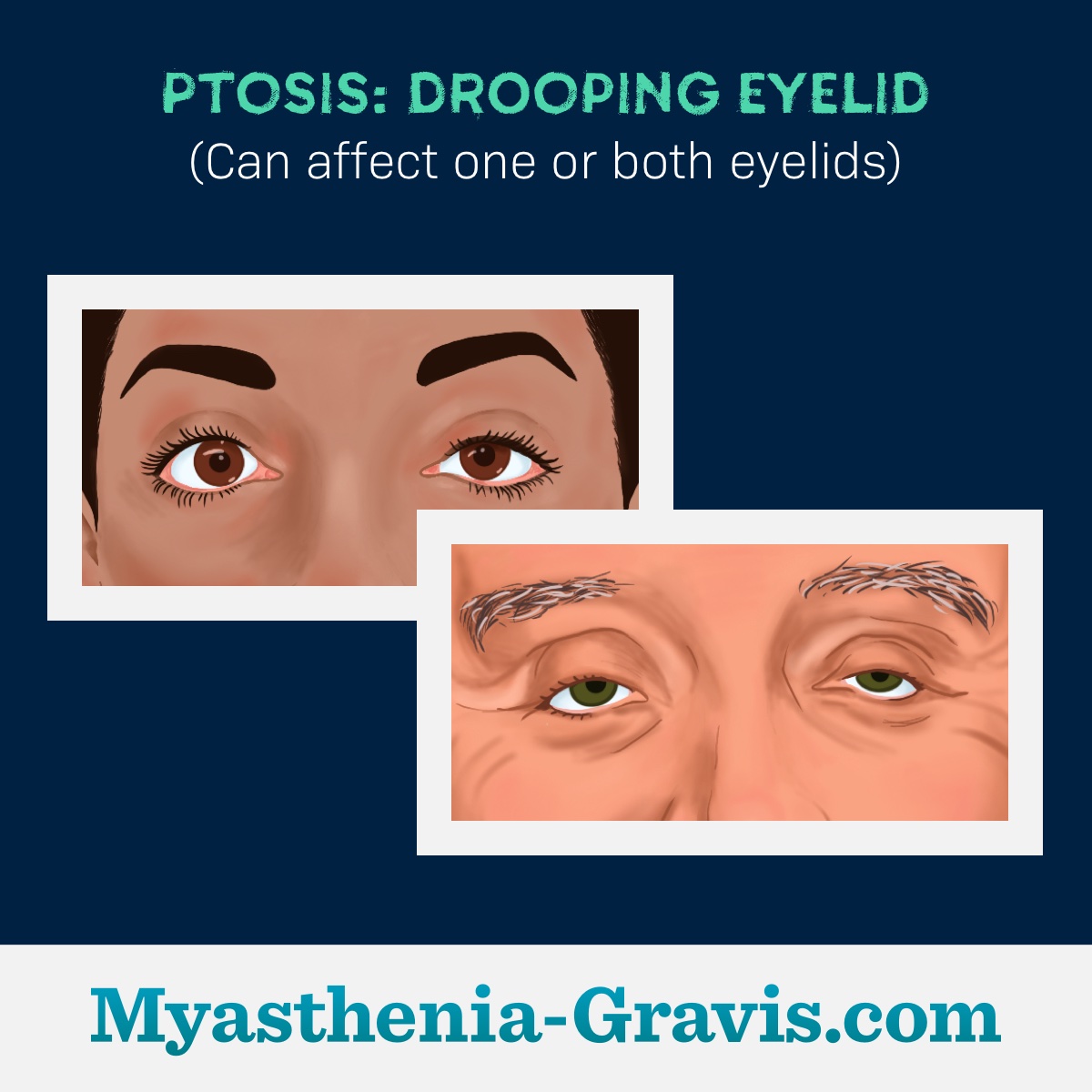 Examples of ptosis or drooping eyelids in one eye or both eyes.