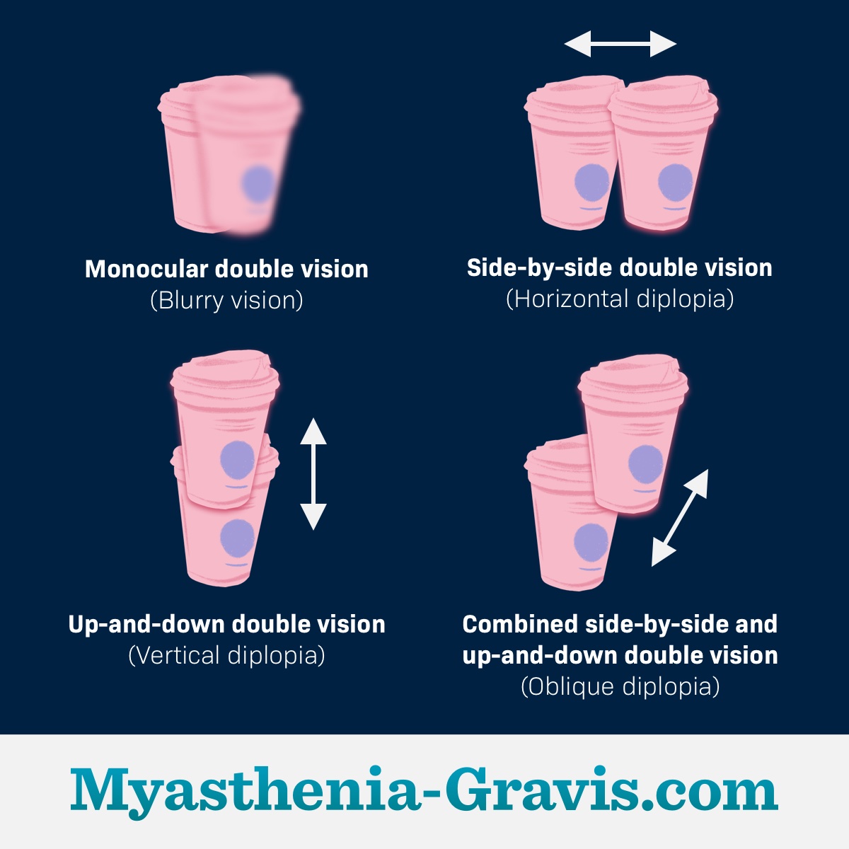Different types of diplopia or double vision in myasthenia gravis.