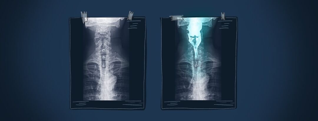 Two x-rays are hanging side by side to highlight a barium swallow study.